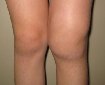 Lyme Arthritis