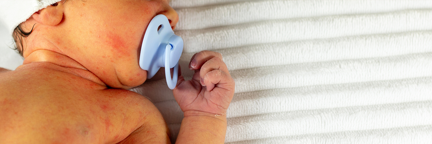 White newborn baby with jaundice.